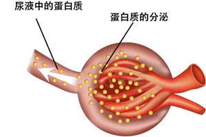 糖尿病肾病的症状是什么？