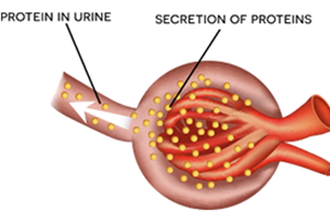 What are the signs of diabetic kidney disease?