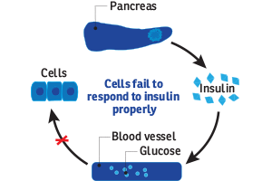 Definition and types of diabetes